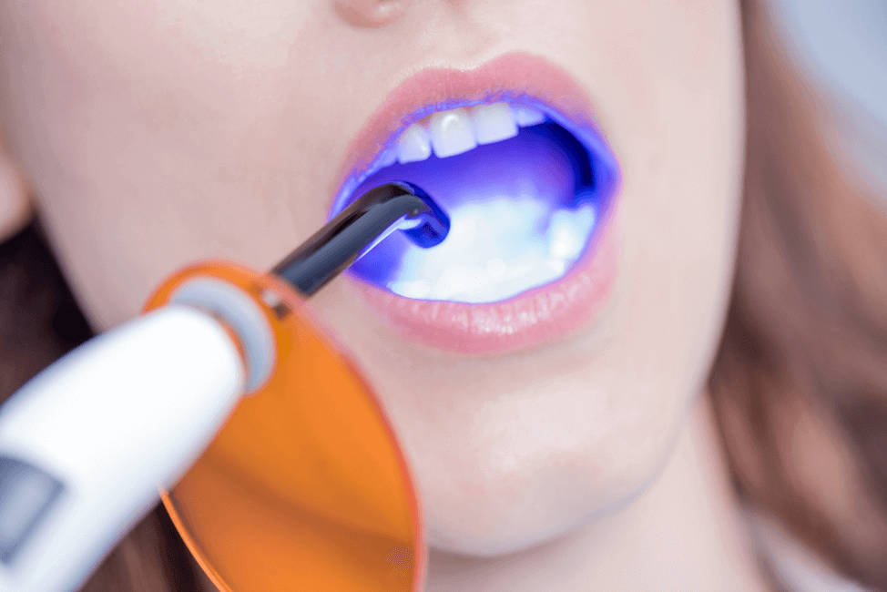 Dentist laser in a patient's mouth