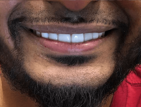 Teeth whitening treatment