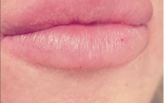 Lips after lip augmentation