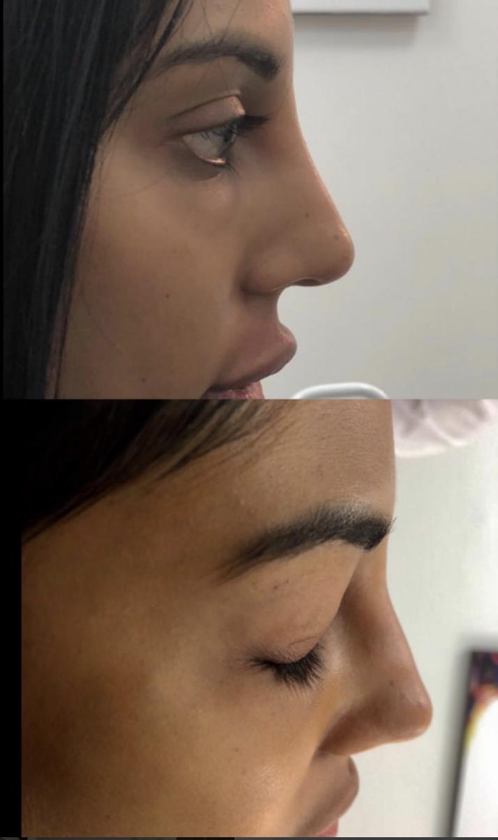 Nose rhinoplasty, before and after photos