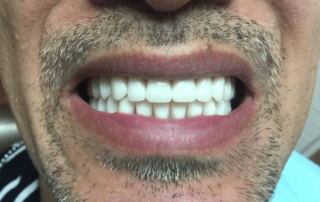 Teeth after whitening in a dental and aesthetic clinic