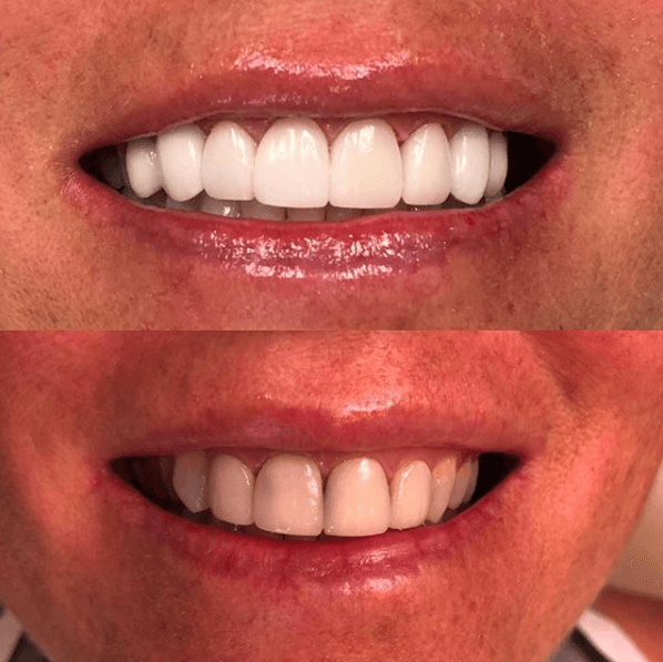 Teeth whitening, before and after photos