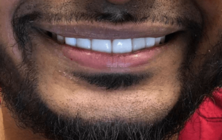 Man's smile after teeth whitening