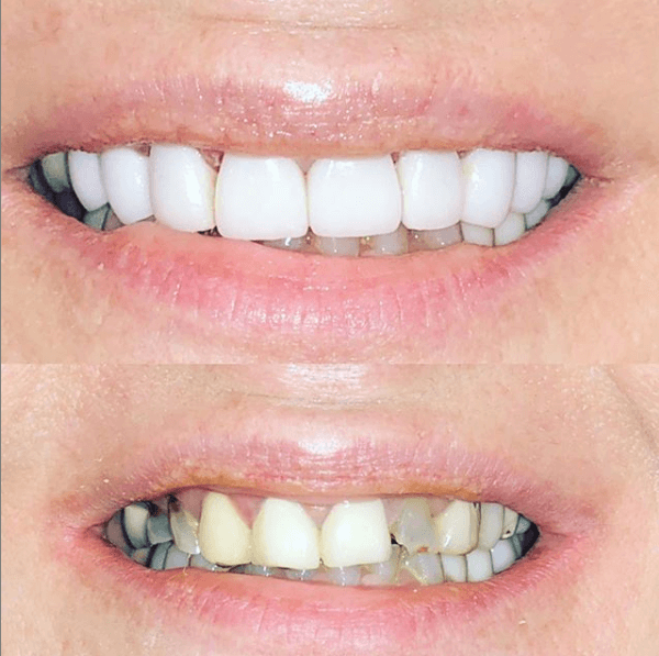 Smile reconstruction, before and after photos