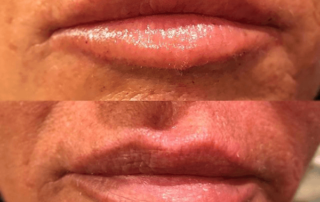 Lips augmentation, before and after photos