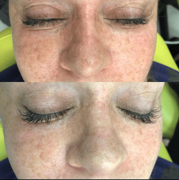 Cheeks before and after augmentation