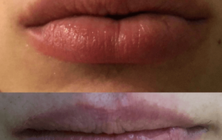 Lips before and after augmentation