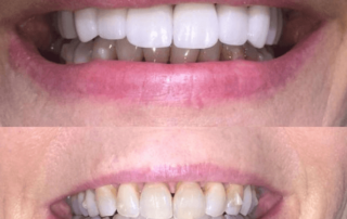 Teeth whitening, before and after photos