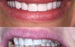 Smile reconstruction, before and after photos