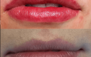 Lips augmentation, before and after photos