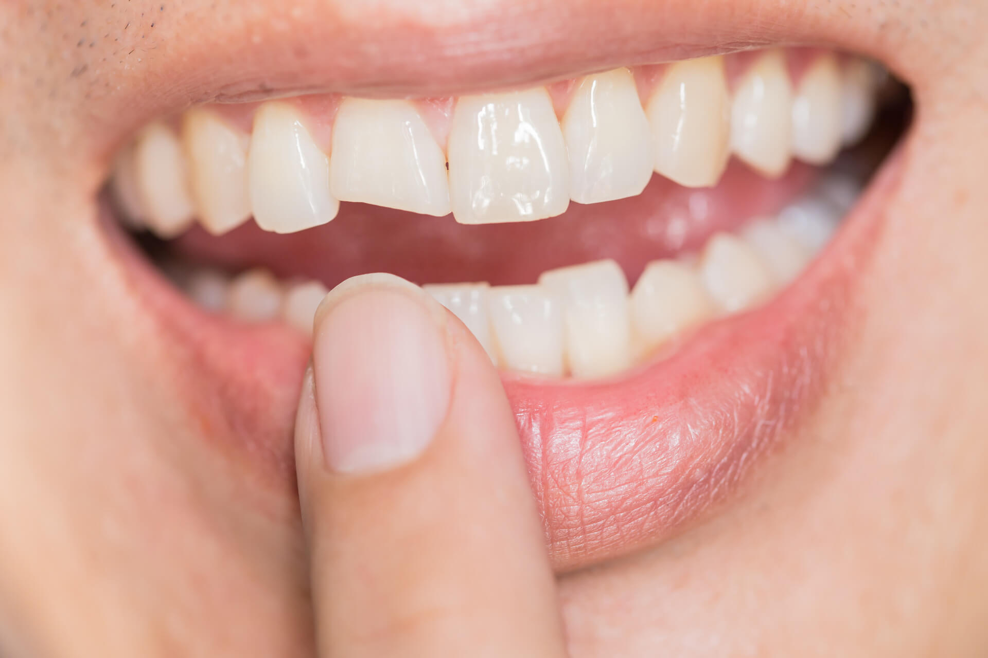 How to Handle a Chipped Tooth- Immediate Steps to Take